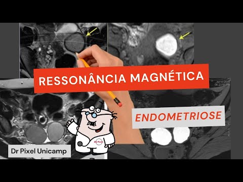 Ressonância magnética na endometriose