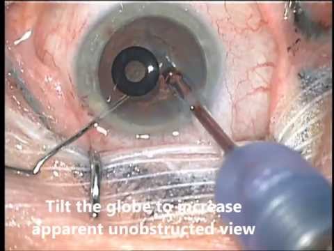 Cataract Surgery in an Eye Implanted with the Kamra Inlay