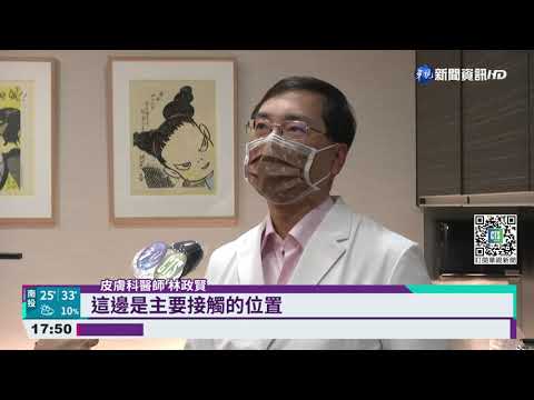 毛毛蟲皮膚炎好發期 每月平均逾10起