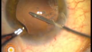 Posterior polar cataract surgery and posterior capsulorhexis + iol