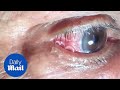 GRAPHIC: Moment 15cm long worm is removed from mans eye