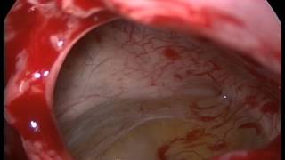 Meatotomia medie, ablație chist sinus maxilar stâng - Dr. Bogdan Mocanu
