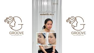 10 ปีกับหลุมสิว