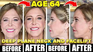 AGE 64 | Facial Rejuvenation Surgery | Deep Plane Face Neck Lift, Dr. Batal USA | Full Journey