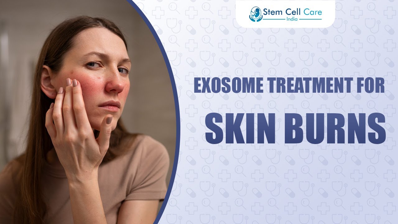 How Exosomes Transform Skin Burn Treatment | Regenerative Medicine Explained