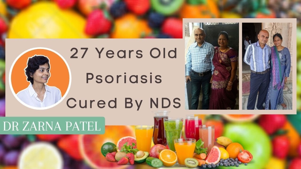 27 Year Old Psoriasis Gone By Dr. Zarna Patel (NDS)  [Patients Experience: Results]