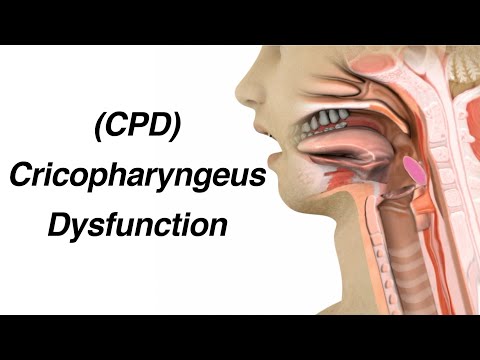 Cricopharyngeus Dysfunction (CPD) Causing Dysphagia or Trouble Swallowing