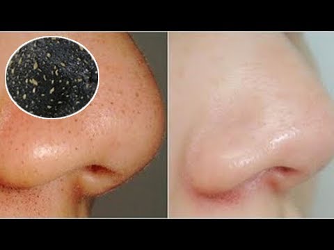 ลูกเกดสีดำที่มีความอ่อนแอ ทำสมาชิกสาวน้อย