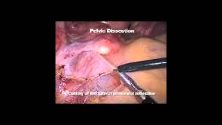 Laparoscopic Restrorative proctocolectomy