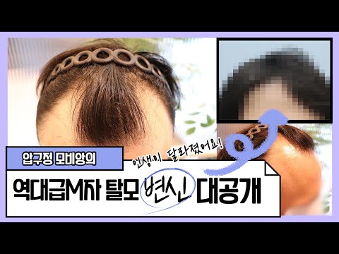 30대 후반,남성의 M자 탈모 역대급 변신 대공개!