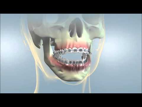 YORK ORTHODONTICS. Orthognathic Surgery Open Bite