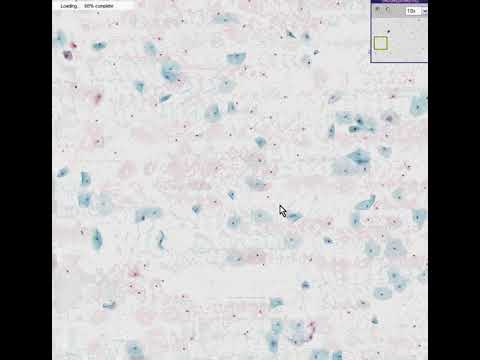 Cervix Low Grade Squamous Intraepithelial Lesion LSIL, AutoCyte  Histopathology - Madeformedical.com