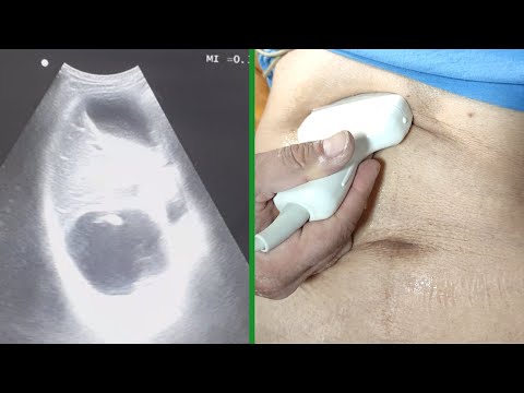 "How to visualize the Kidney, Liver, Gallbladder, Aorta, Spleen, and Heart using FAST ultrasound?"