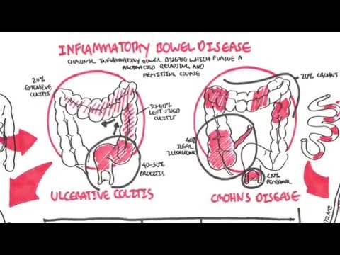 Inflammatory Bowel Disease (Overview, Crohn's and Ulcerative Colitis)