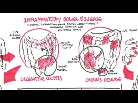 colitis ulcerosa belféreg