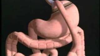Gastric Bypass animation Gastric Bypass animation