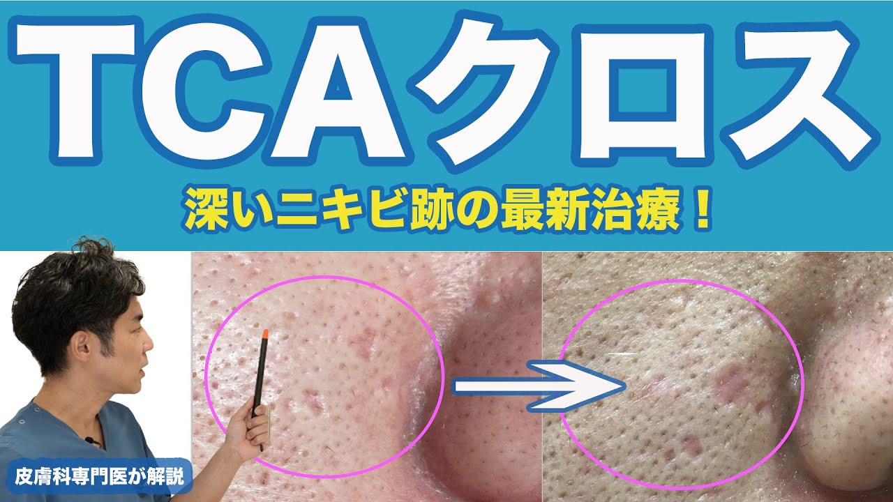 【ニキビ跡の最新治療】TCAクロスとは！？