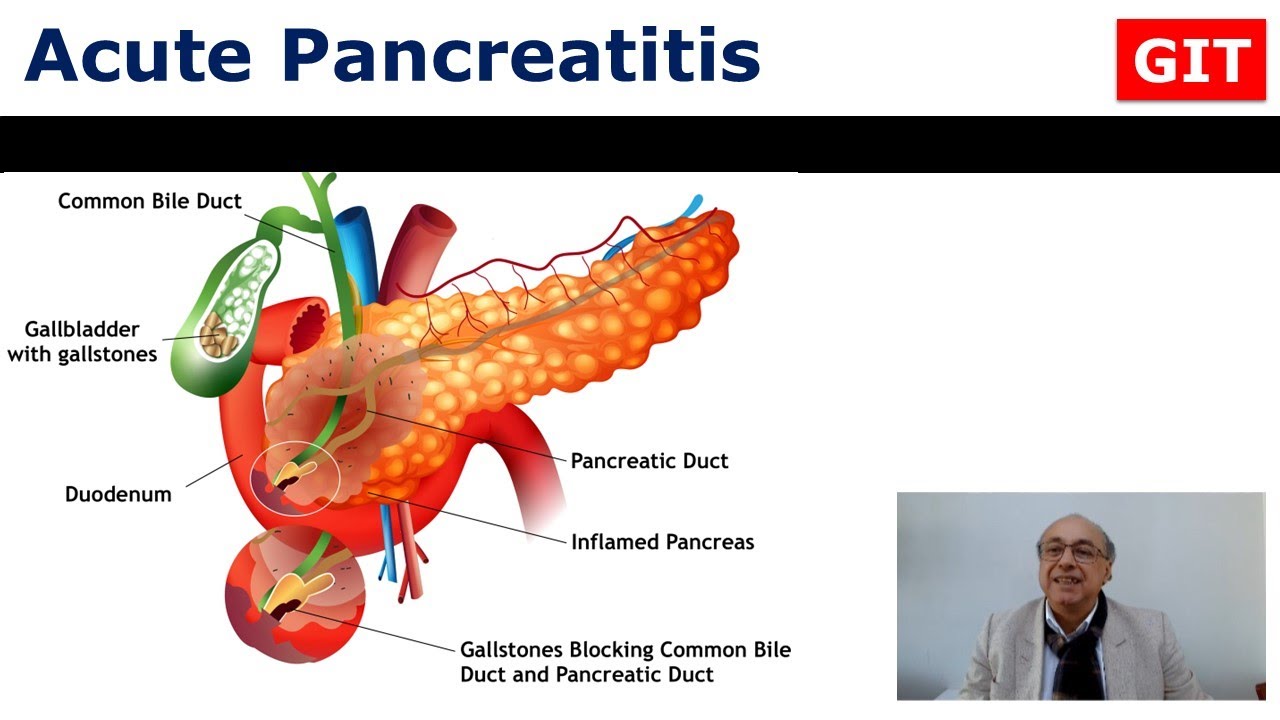 Acute Pancreatitis (GIT) - Internal Medicine