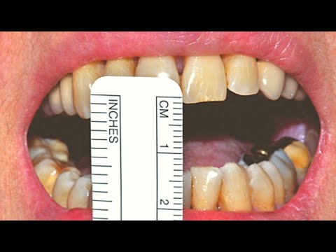 How to Root Canal in Tight Spaces - Limited Opening