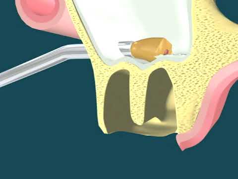 Dental Video of Root Tip in Sinus Retraction - The Tooth