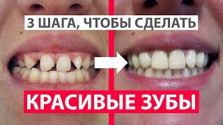 Как сделать красивые зубы? 3 шага. Брекеты и реставрация зубов. Цены