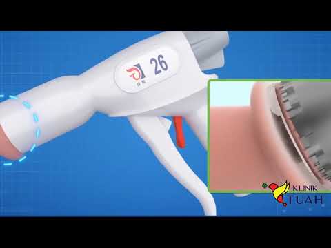 How is Adult Circumcision done using Stapler Circumcision Technique .