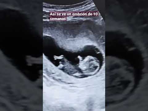 10 SEMANAS HEMATOMAS DEBES GUARDAR REPOSO