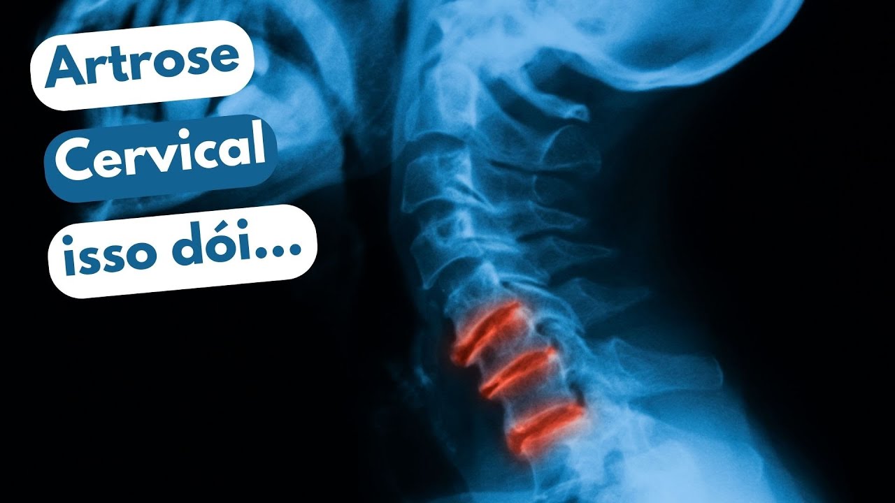 ESPONDILOARTROSE CERVICAL - Dr. Prof. Nelson Marques