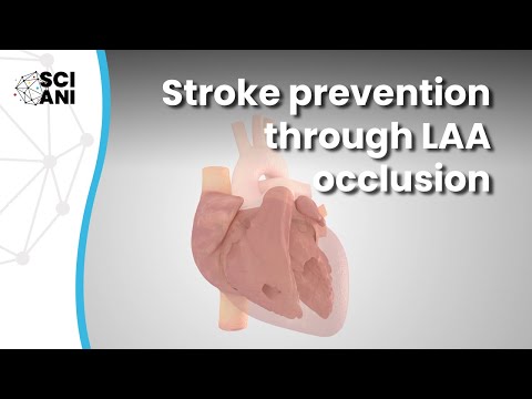 Concomitant surgical left atrial appendage occlusion prevents strokes in patients with AF