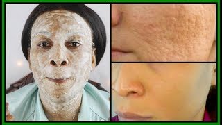 THE SECRET TO SHRINK LARGE PORES IN 3 DAYS |100% RESULTS | MAGIC REMEDY |Khichi Beauty