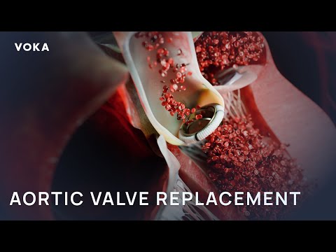 Aortic Valve Replacement: Step-by-Step Open-Heart Surgery 3D Animation