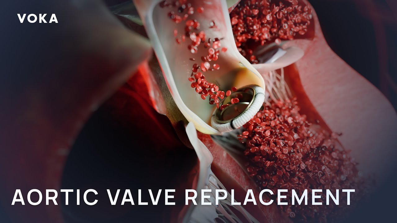 Aortic Valve Replacement: Step-by-Step Open-Heart Surgery 3D Animation