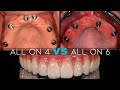 Should I Get 4 or 6 Dental Implants?