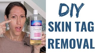 How to Get Rid of a Skin Tag | Natural Skin Tag Removal Home Remedies & Tips