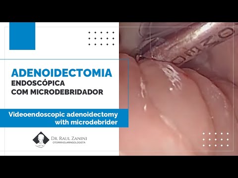 Miniatura: Adenoidectomia Endoscópica com Microdebridador
