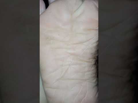 ที่ neurodermatitis การรักษาดังกล่าว โรคเรื้อนเป็นโรคสะเก็ดเงิน