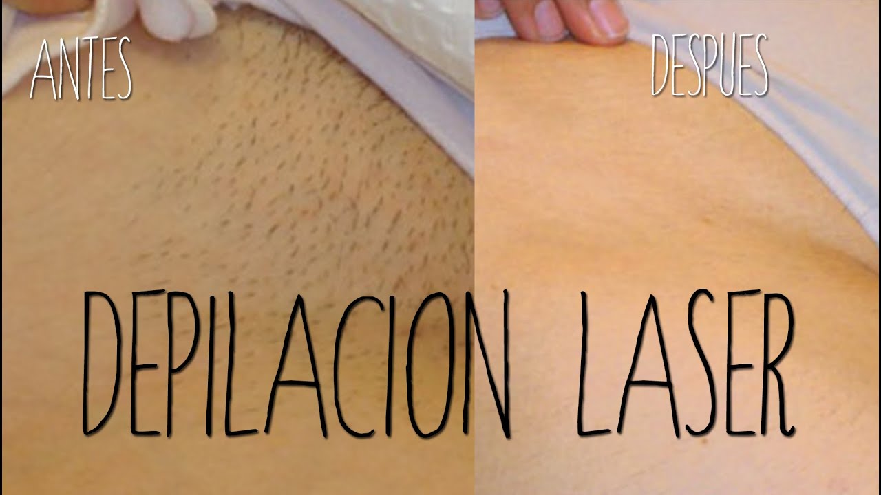 Watch Depilación láser: 7 cosas que debes saber Now Depilación láser: 7 cosas que debes saber