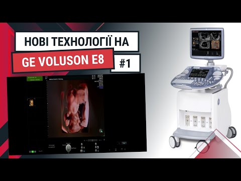Технологія Radiant Flow на УЗД апараті GE Voluson E8 - Статті RH