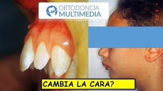 Cambia la cara la Ortodoncia Te lo explico super fácil !!