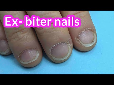 Nail Transformation of Ex- Biter With Hard Gel on Forms