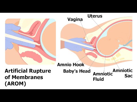 AROM - Artificial Rupture of Membranes