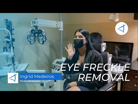 Ingrid Medeiro's Eye Freckle Removal treatment experience.