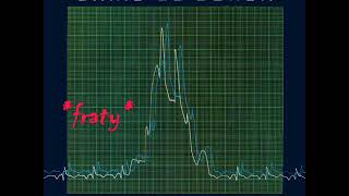 Chris De Burgh - High On Emotion