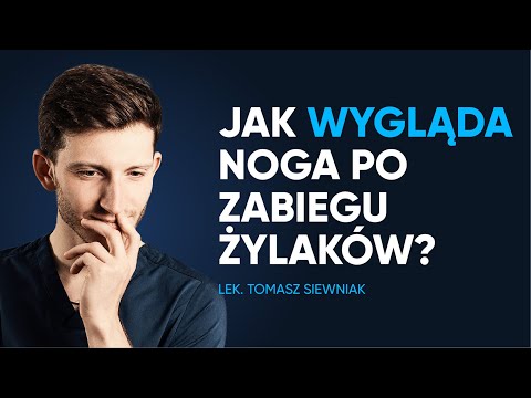 Jak wygląda noga po laserowym usuwaniu żylaków?