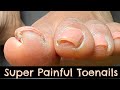 EXTRACTION OF SUPER PAINFUL INCURVATED TOENAILS