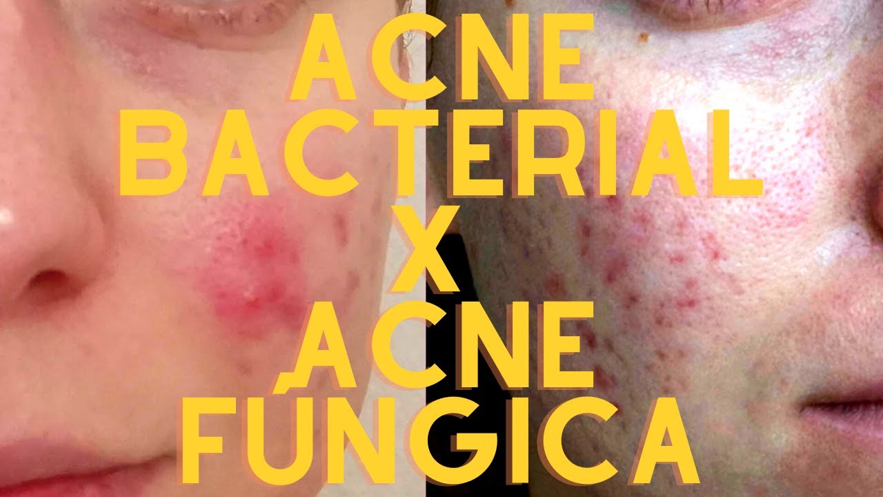 Como Saber se Você Tem ACNE FÚNGICA? | Principais Características da Acne Fúngica e como Analisar 🔍
