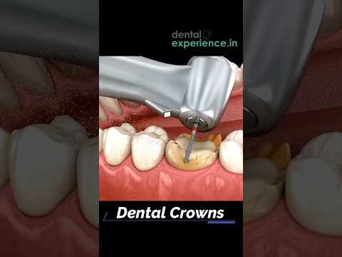 Dental Crown | Zirconia Teeth Crown | Tooth Cap.