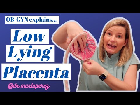 Low Lying Placenta Explained: Risks, Sex, Exercise, C-section vs Vaginal birth, Marginal previa