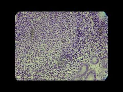 Peyer's Patch in Duodenum