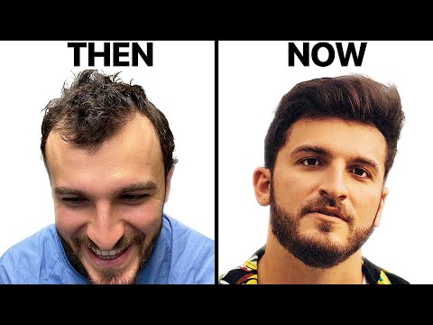 Hair Transplant Surgery Changed My Life @ZaneHijazi | Surgeon Reacts​